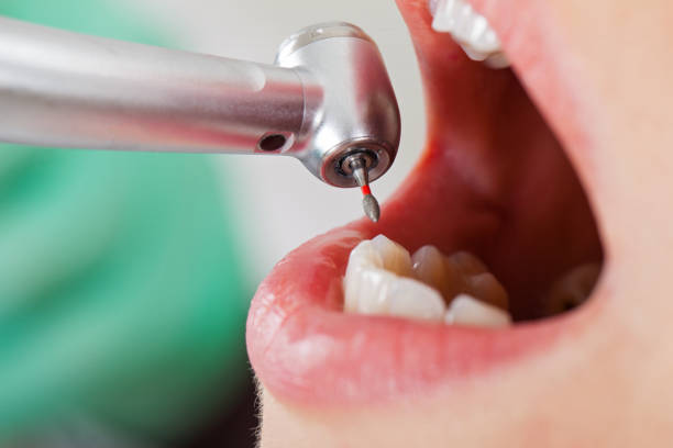 Best Emergency Wisdom Tooth Extraction in Levelland, TX